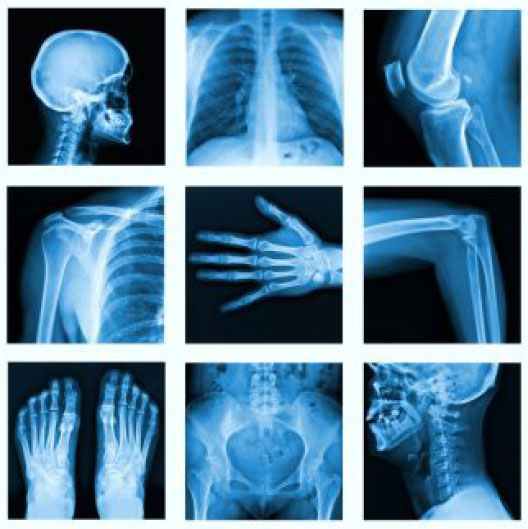 Osteoporosis